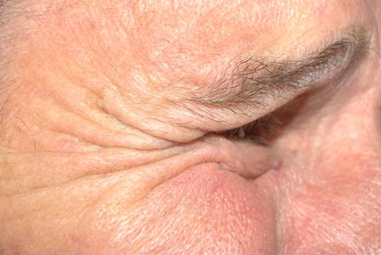 Eye Wrinkles