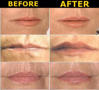 Lips Before and After