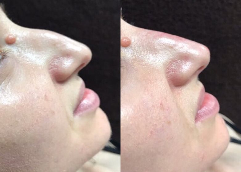 rhinoplasty